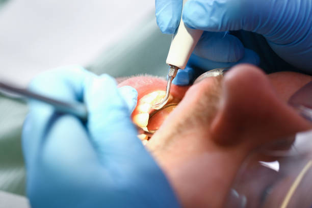 Best Emergency Root Canal Treatment in Reisterstown, MD